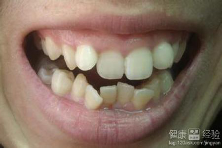 牙齿过度矫治了怎么办