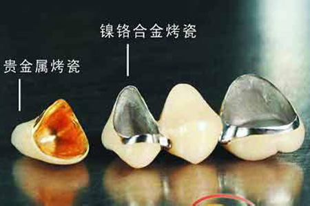 烤瓷牙的使用寿命是多久？