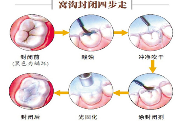 合肥包河区做窝沟封闭哪家好？