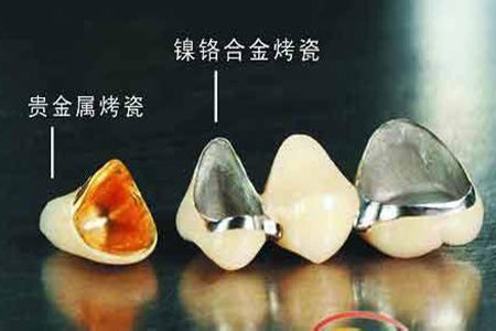 合肥包河区分析选择烤瓷牙的利与弊？