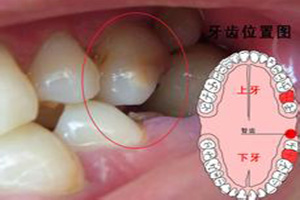 牙痛该怎么办？