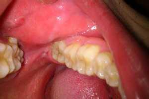 长智齿牙龈肿痛怎么办？
