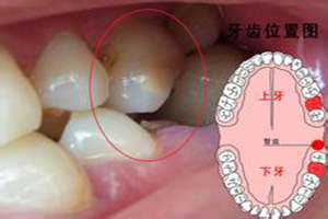 合肥拔智齿价格？