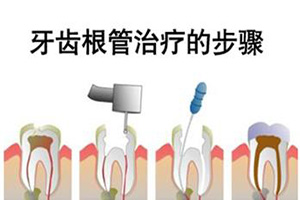 合肥牙齿根管的治疗过程？