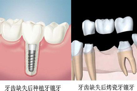 合肥镶牙费用大概要多少钱?