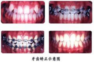 合肥牙齿矫正？