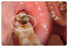 合肥治疗蛀了牙的价格是多少?