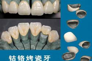 在合肥应该如何选择烤瓷牙？