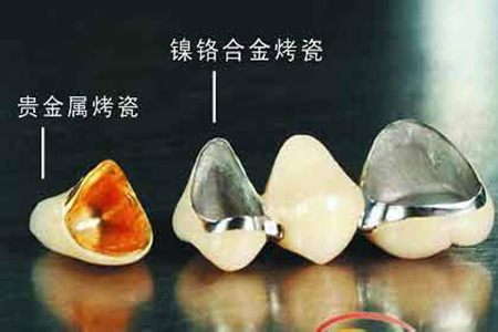 烤瓷牙能使用多长时间？