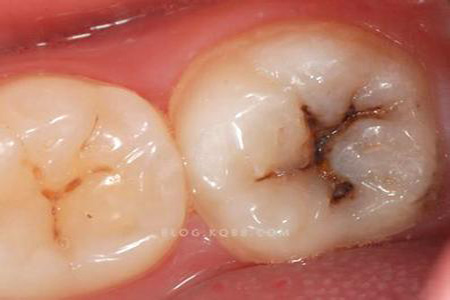 合肥修补蛀了牙需要多少钱？