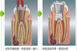 在合肥应该怎样选择补牙材料？