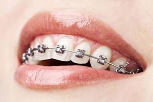 矫正牙齿的危害有哪些？