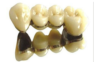 做烤瓷牙后导致牙齿酸痛的原因有哪些?