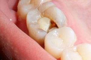 合肥补牙材料有哪些？