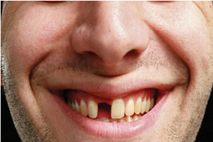 牙齿缺失会导致面部变形