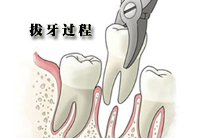 拔牙不会造成牙齿松动吗?