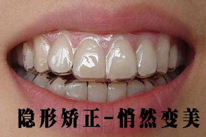 合肥隐形矫正牙齿多少钱？
