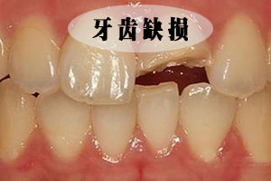 牙齿断了怎么修复才好？