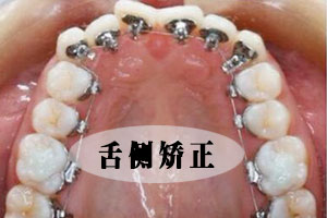 合肥口腔做牙齿矫正要花多少钱？