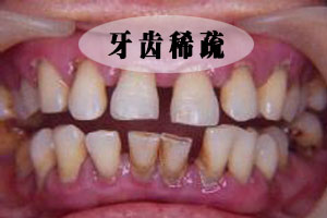 牙齿疏松有什么危害呢?