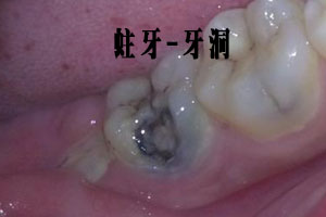 盘点可以可靠预防蛀了牙产生的食物？