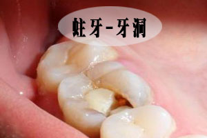 龋坏发病的相关知识有什么？