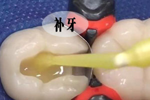 免费窝沟封闭——送给孩子好的礼物