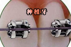 牙颌面畸形的矫正方法及需求人群有哪些？