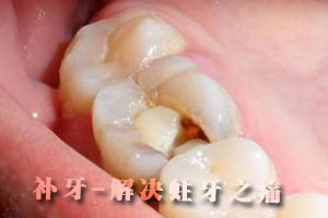 合肥补颗牙齿要多少钱？