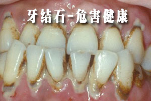 牙周炎有什么危害?