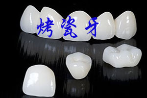 烤瓷牙有哪些种类？