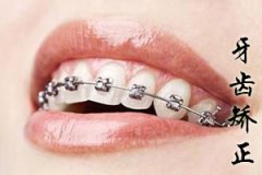 合肥牙齿矫正多少钱?