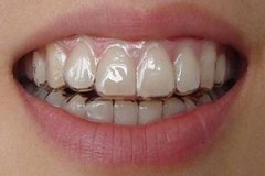  牙齿矫正需要多长时间？