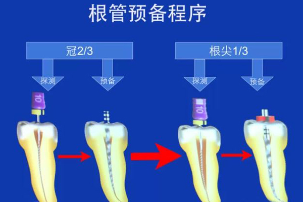 什么情况下要做根管的治疗？