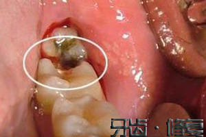 智齿蛀了牙了需要拔牙吗？