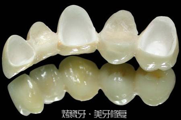 关于烤瓷牙适应症是什么?