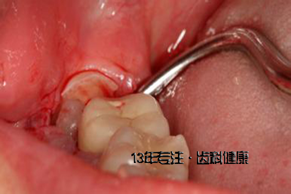 牙痛可以拔牙吗？