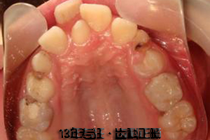 合肥儿童出现多生牙怎么治疗?
