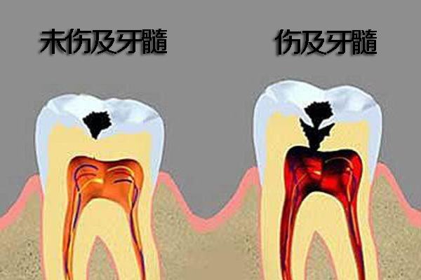 孩子龋坏疼痛怎么办？