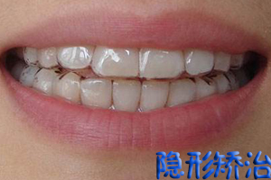 牙齿矫正术前应做哪些检查呢?