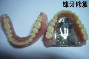 拔牙之后要镶牙吗?