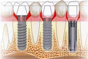 种植牙危害有哪些值得知道？