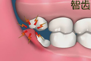 智齿一定要拔掉吗？