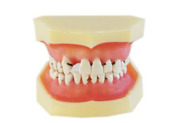 牙齿不齐可分为哪几类？