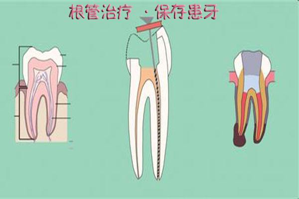 合肥根管的治疗的注意事项有哪些？