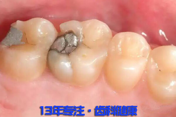 牙龈裂