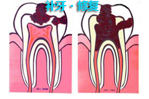 小孩虫牙该怎么治疗