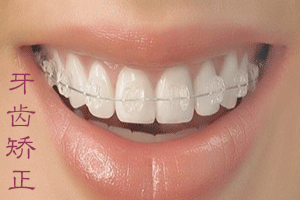 合肥牙齿矫正过程？