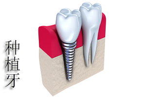 合肥种植牙齿多少钱
