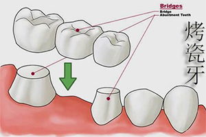 合肥烤瓷牙对牙齿有伤害吗？